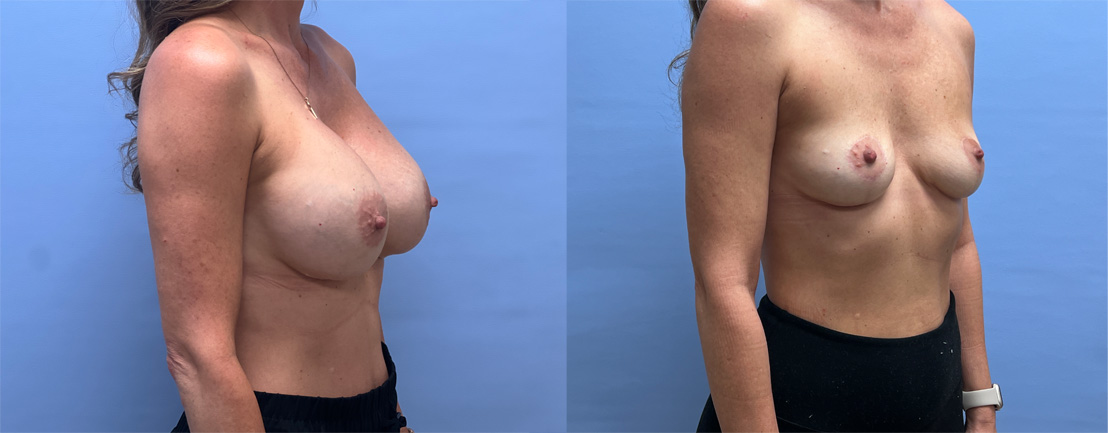 Breast Explant Patient 24 | Dr. Shaun Parson