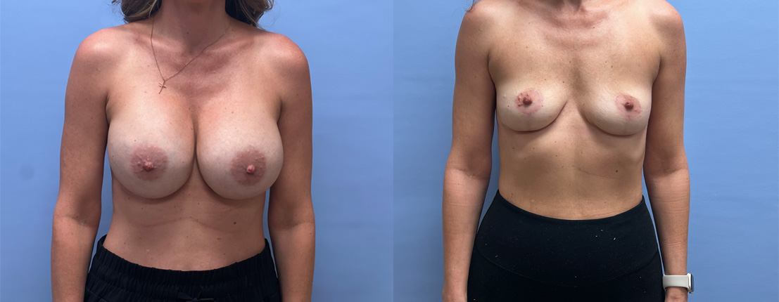 Breast Explant Patient 24 | Dr. Shaun Parson