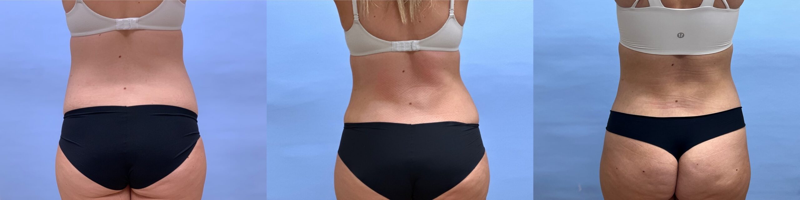 Tummy Tuck with Liposuction, progression photos | Dr. Shaun Parson