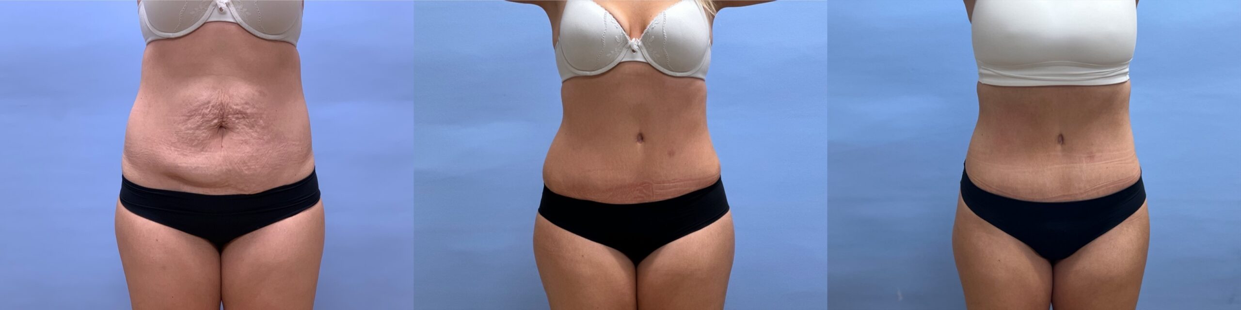 Tummy Tuck with Liposuction, progression photos | Dr. Shaun Parson