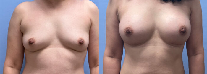 Breast Augmentation Patient 64 | Dr. Shaun Parson Plastic Surgery