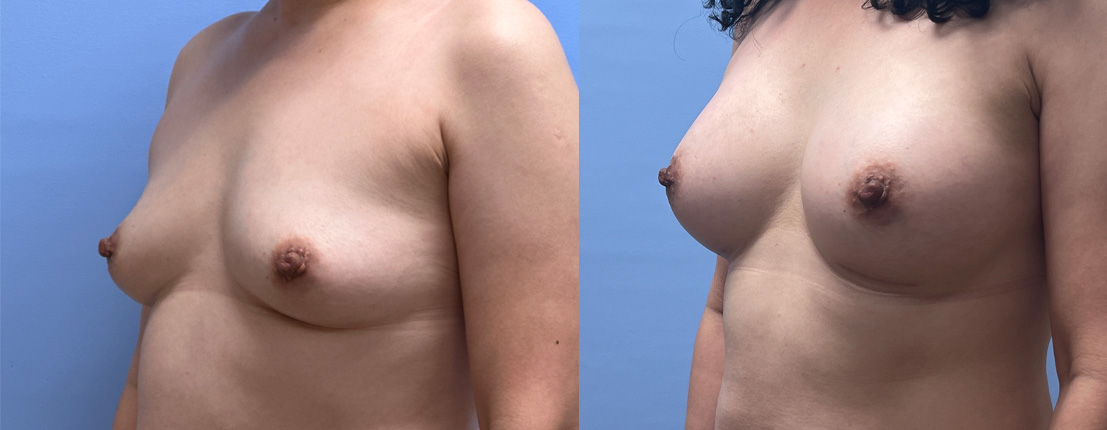 Breast Augmentation Patient 64 | Dr. Shaun Parson Plastic Surgery