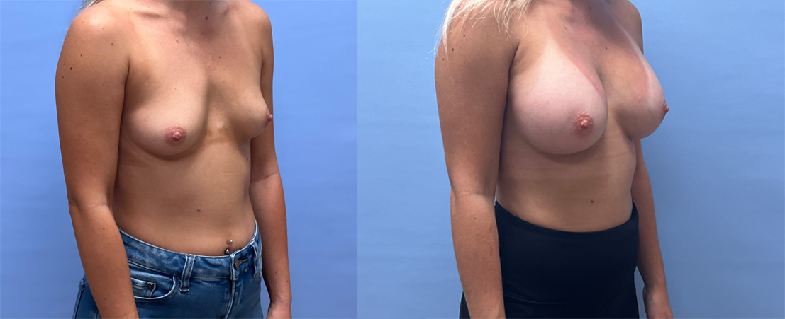 Breast Augmentation Patient 64 | Scottsdale Plastic Surgeon