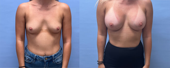 Breast Augmentation Patient 64 | Scottsdale Plastic Surgeon