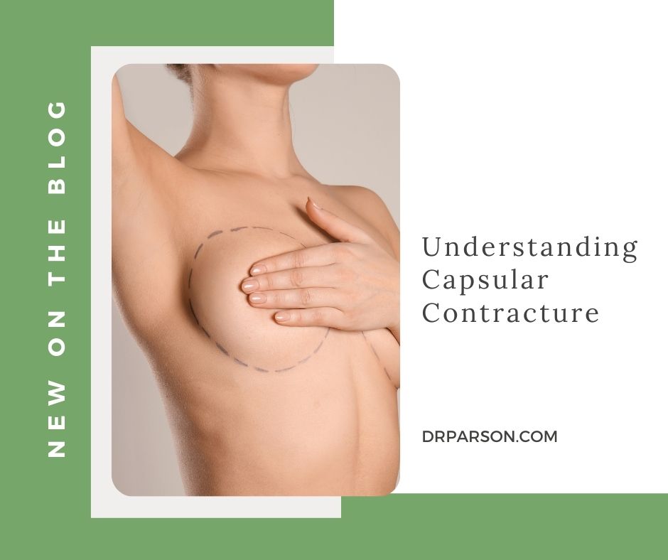 Understanding Capsular Contracture