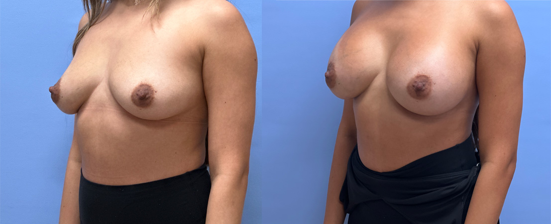 Breast Augmentation Patient 67 | Dr. Shaun Parson, Scottsdale, AZ