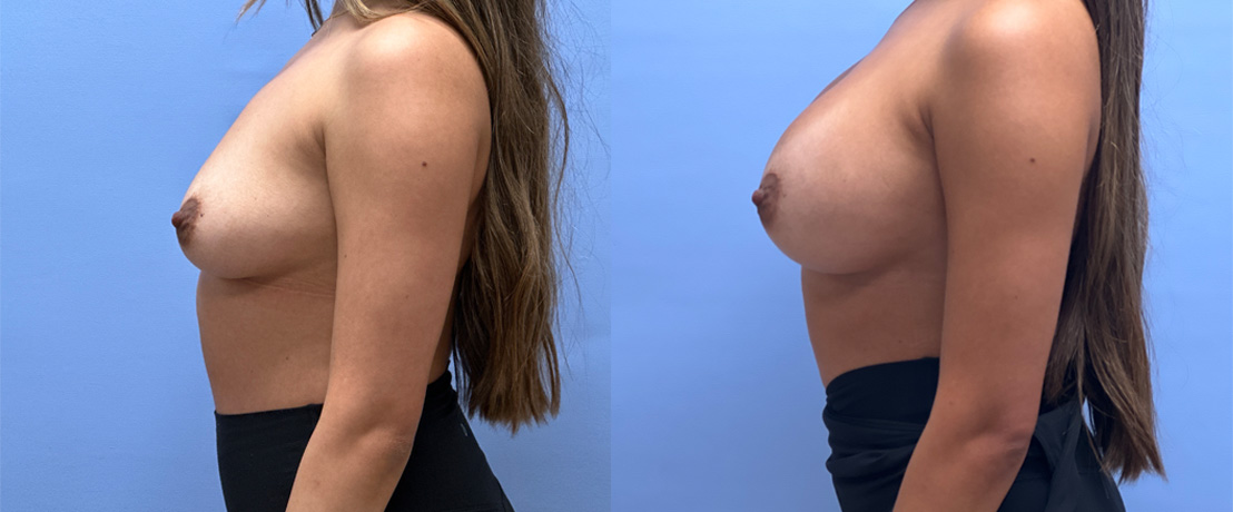 Breast Augmentation Patient 67 | Dr. Shaun Parson, Scottsdale, AZ