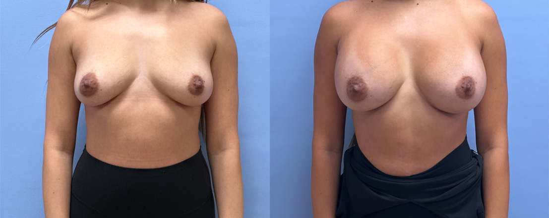 Breast Augmentation Patient 67 | Dr. Shaun Parson, Scottsdale, AZ