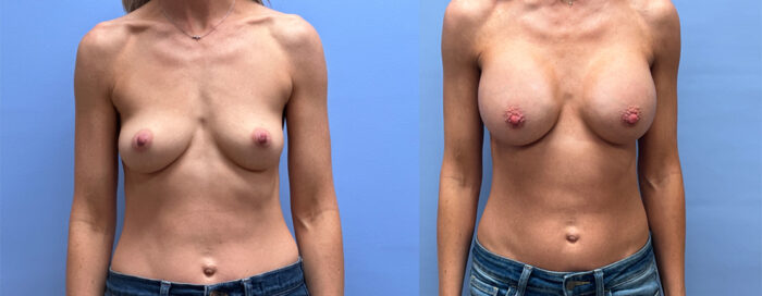 Breast Augmentation Patient 66 | Dr. Shaun Parson Plastic Surgery