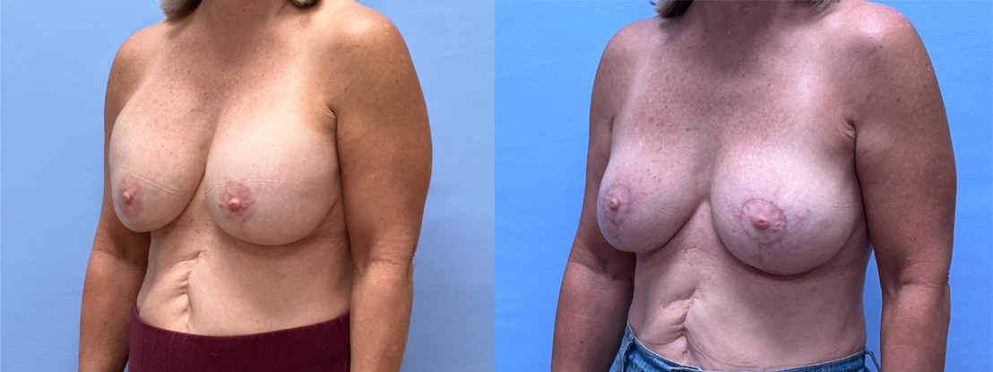 Breast Explant Patient 24 | Dr. Shaun Parson Plastic Surgery, Scottsdale