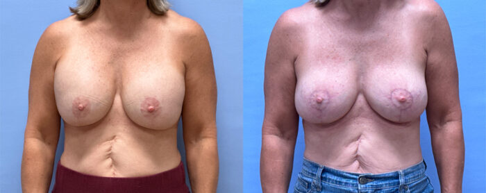 Breast Explant Patient 24 | Dr. Shaun Parson Plastic Surgery, Scottsdale