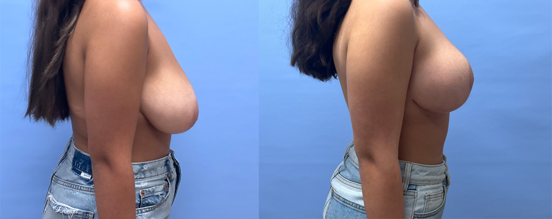 Breast Lift Patient 26 | Dr. Shaun Parson, Scottsdale