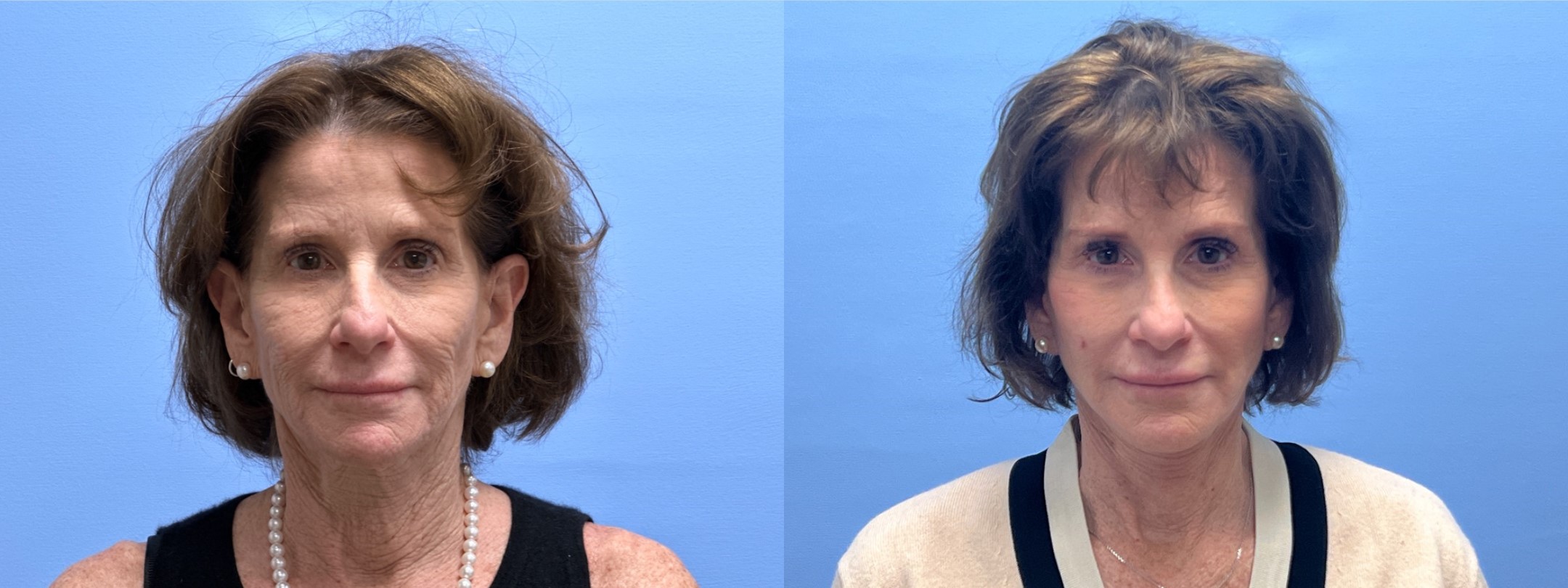 Necklift/Facelift Patient 34