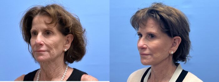 Necklift/Facelift Patient 34