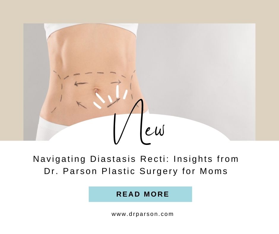 Navigating Diastasis Recti Blog