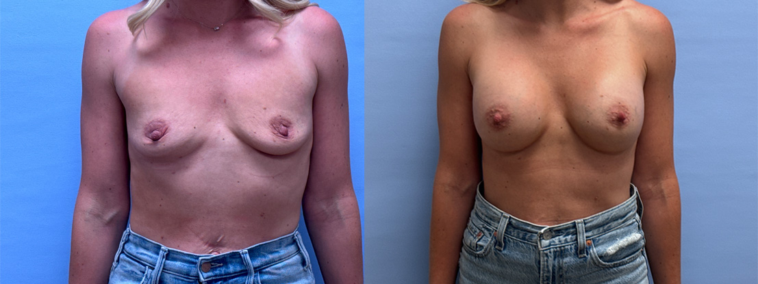 Breast Augmentation Patient 68 | Dr. Shaun Parson, Scottsdale