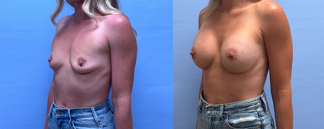 Breast Augmentation Patient 68 | Dr. Shaun Parson, Scottsdale