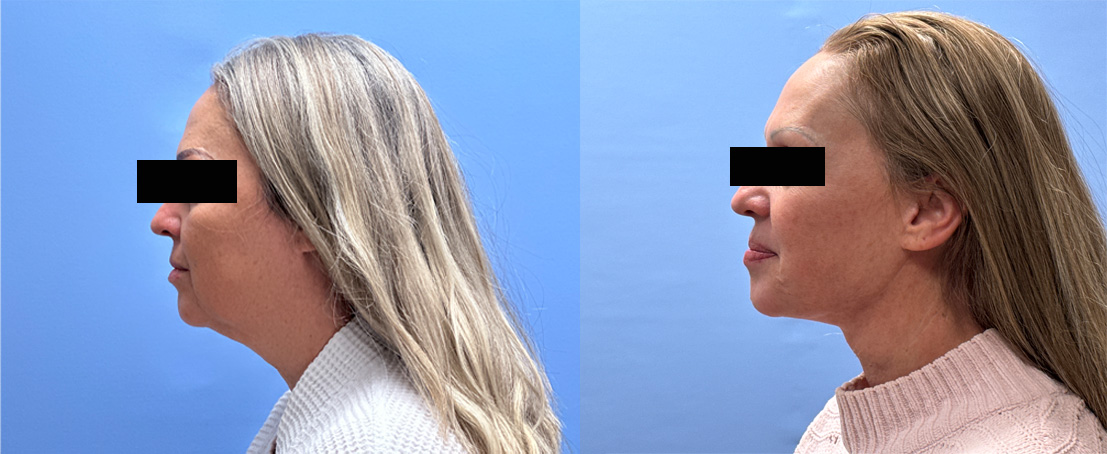 Necklift & Lower Facelift Patient 35| Dr. Shaun Parson Plastic Surgery