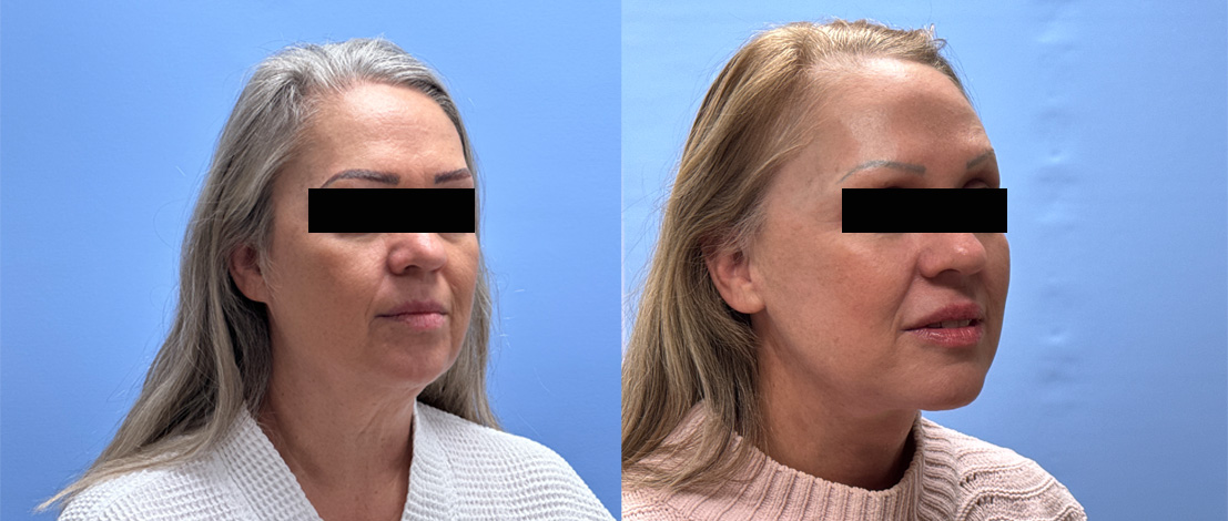 Necklift & Lower Facelift Patient 35| Dr. Shaun Parson Plastic Surgery