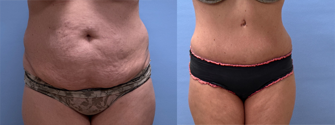 Tummy Tuck Patient 57 | Dr. Shaun Parson Plastic Surgery