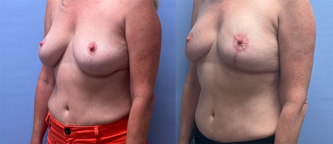 Breast Lift Patient 27 | Dr. Shaun Parson Plastic Surgery