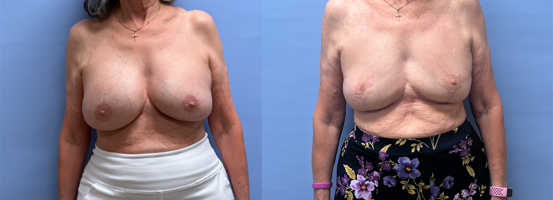 Breast Explant Patient 26 | Dr. Shaun Parson Plastic Surgery