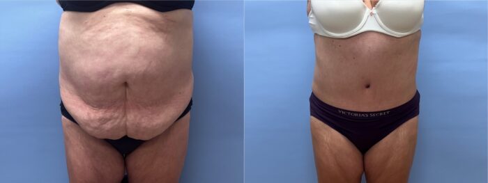 Tummy Tuck Patient 58 | Dr. Shaun Parson Plastic Surgery