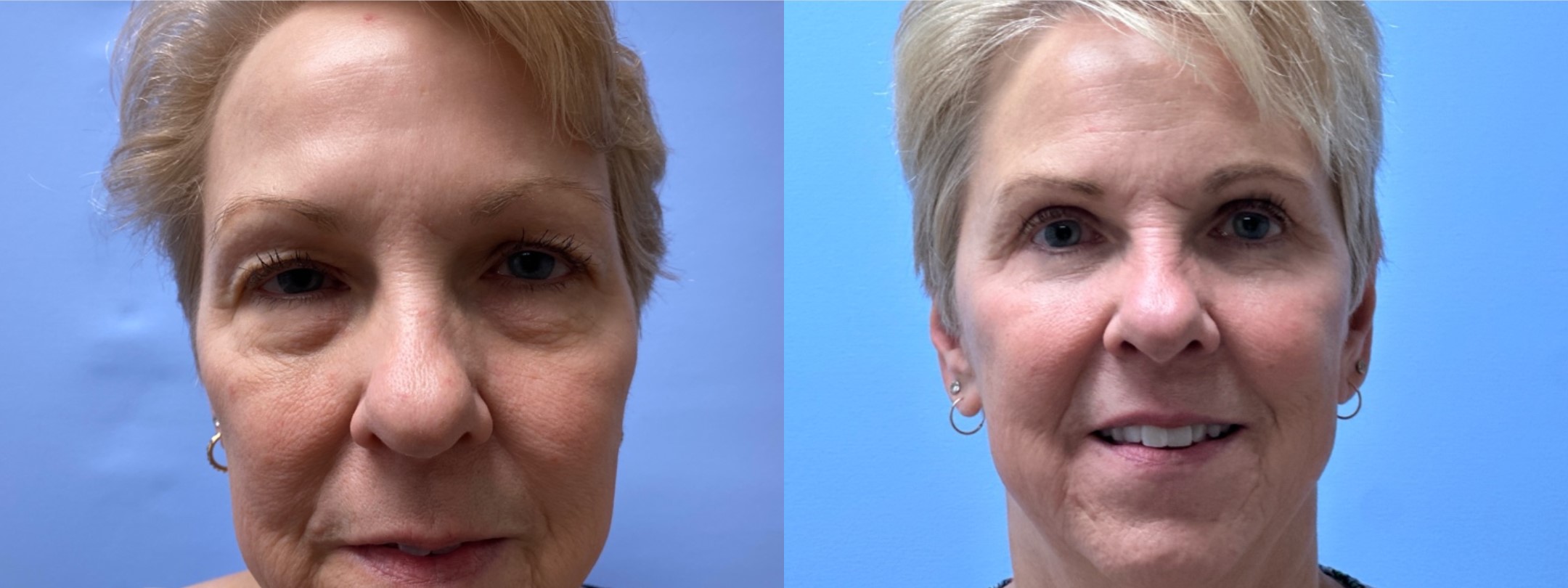 Eyelid Surgery Patient 44 | Dr. Shaun Parson Plastic Surgery