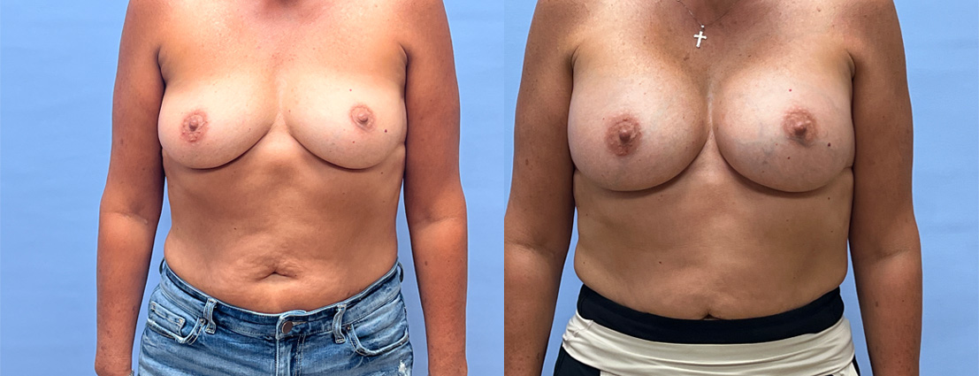 Breast Augmentation 70 | Dr. Shaun Parson Plastic Surgery