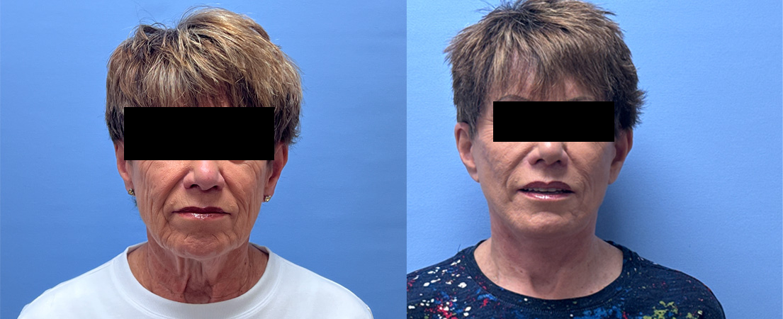 Facelift Patient 36 | Dr. Shaun Parson Plastic Surgery