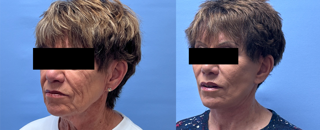 Facelift Patient 36 | Dr. Shaun Parson Plastic Surgery