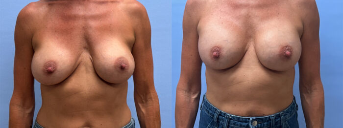 Breast Revision Patient 21 | Dr. Shaun Parson Plastic Surgery