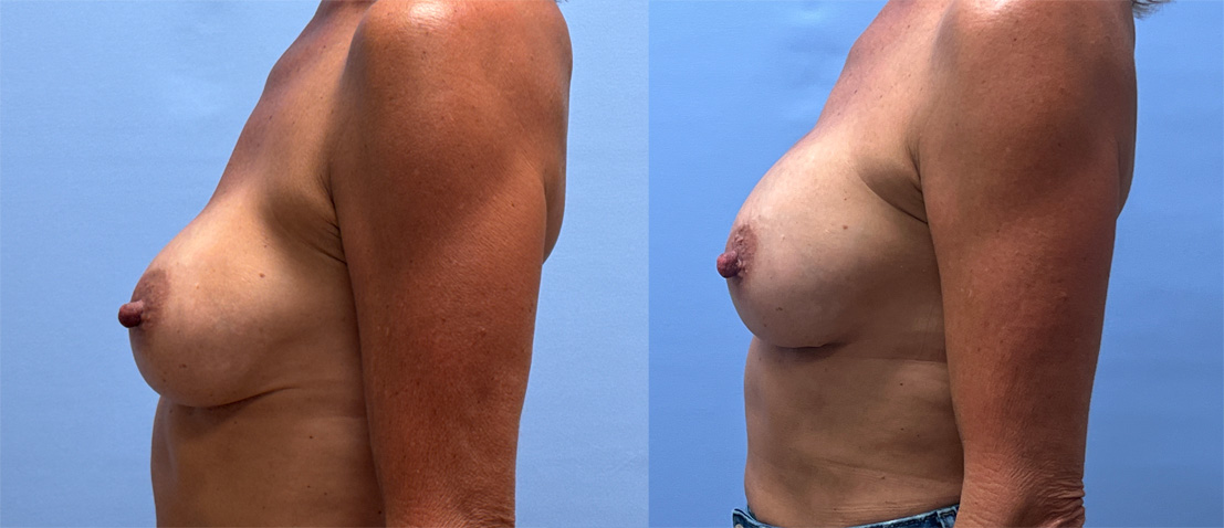 Breast Revision Patient 21 | Dr. Shaun Parson Plastic Surgery