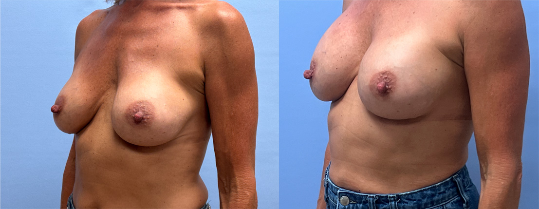 Breast Revision Patient 21 | Dr. Shaun Parson Plastic Surgery