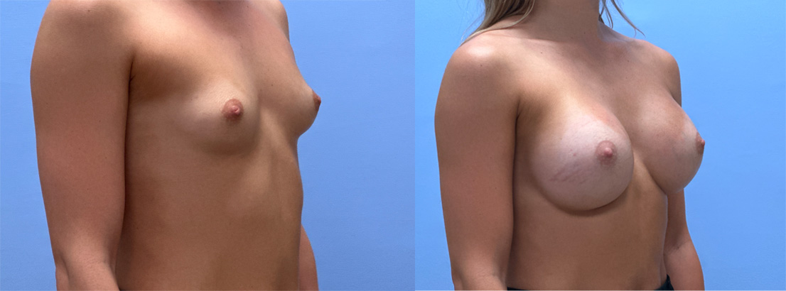 Breast Augmentation Patient 71 | Dr. Shaun Parson