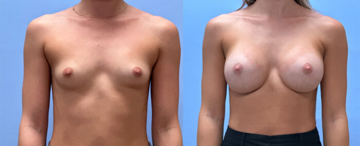 Breast Augmentation Patient 71 | Dr. Shaun Parson