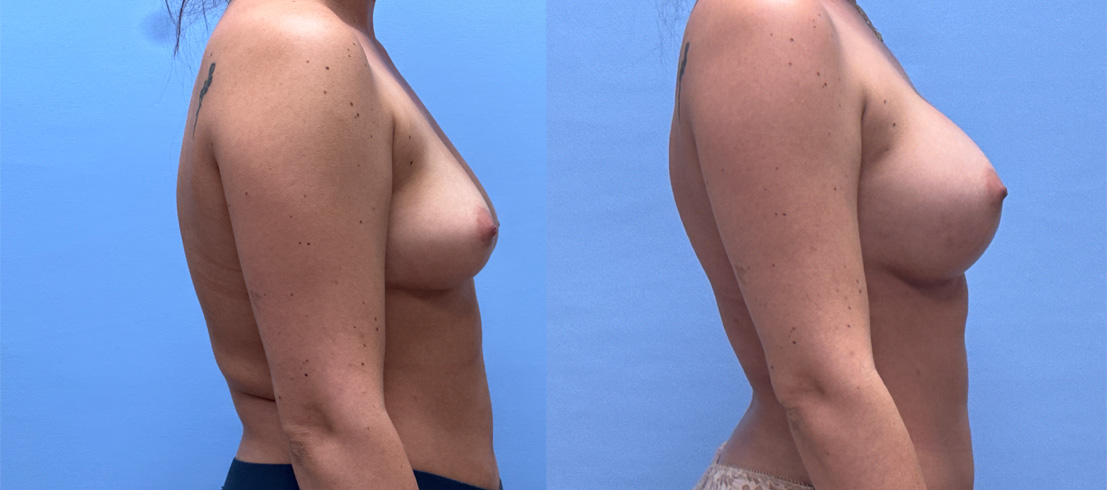 Breast Augmentation patient 72 | Dr. Shaun Parson