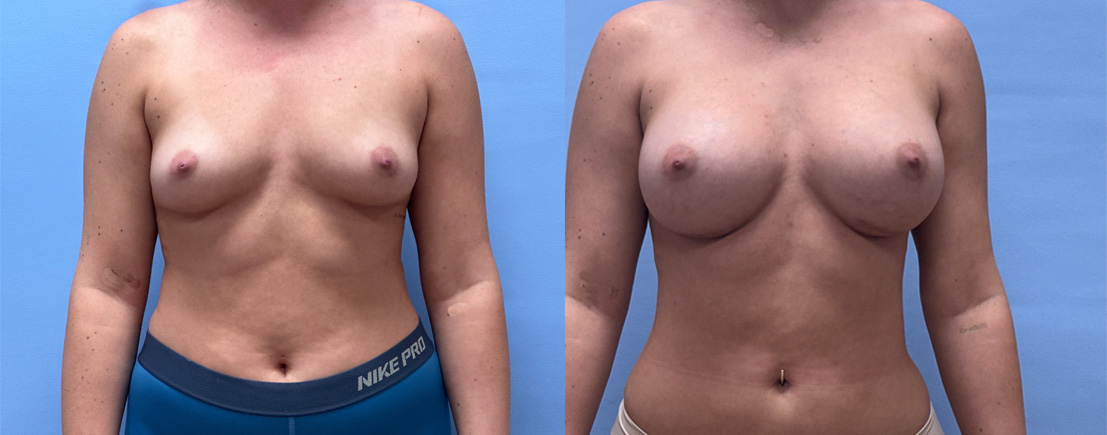 Breast Augmentation patient 72 | Dr. Shaun Parson