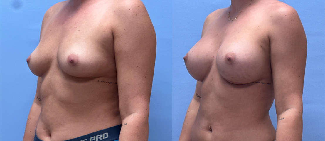 Breast Augmentation patient 72 | Dr. Shaun Parson