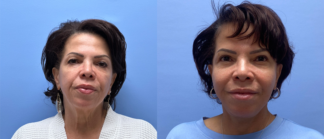 Facelift Patient 37 | Dr. Shaun Parson