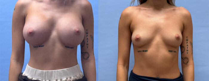 Breast Augmentation Patient 71 | Dr. Shaun Parson