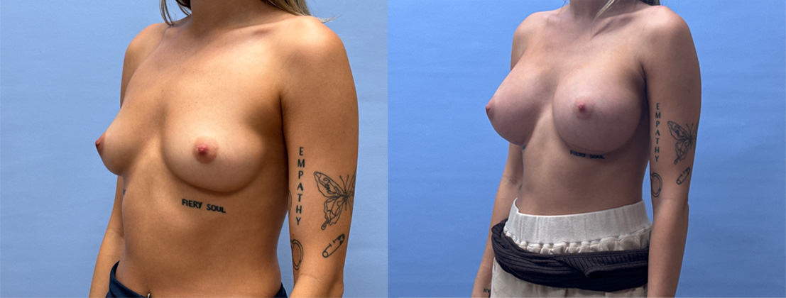 Breast Augmentation Patient 71 | Dr. Shaun Parson