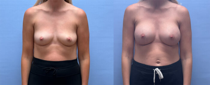 Breast Augmentation Patient 73 | Dr. Shaun Parson