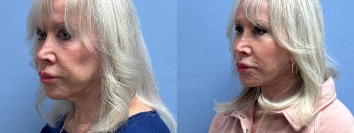 Buccal Fat Removal + Facelift Patient 38