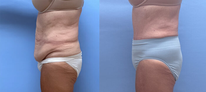 Scottsdale Tummy Tuck 59 | Dr. Shaun Parson